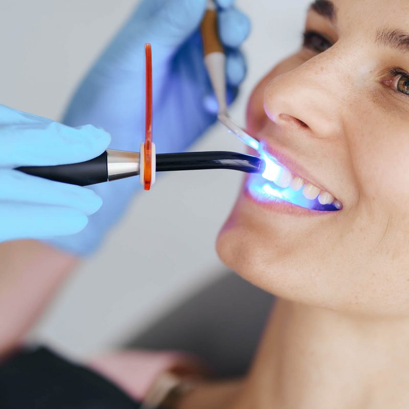 Photopolymer, dentist fixes a seal to a young patient woman, photopolymer lamp